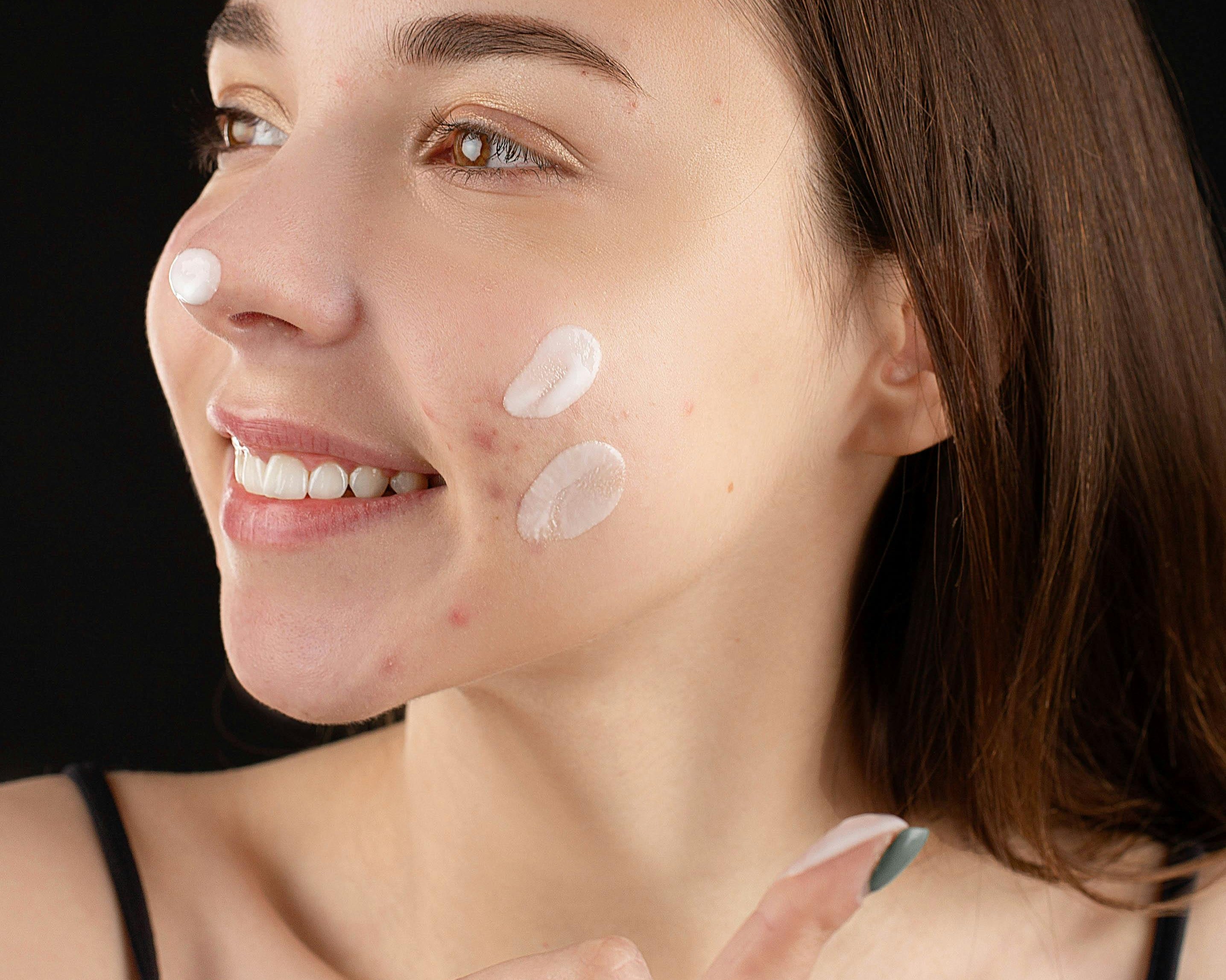 Crème visage pour peau acnéique : quels ingrédients rechercher ?